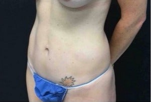 35-44 year old woman treated with Tummy Tuck after 3219182