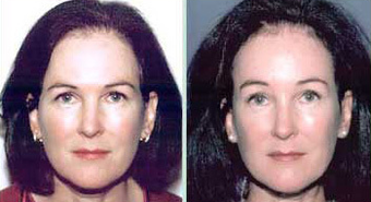 Young Female Treated for Brow Ptosis and Crow's Feet before 1130477