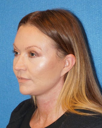 44 year old woman treated with Facelift 3576622