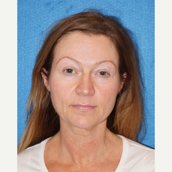44 year old woman treated with Facelift before 3576622