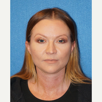 44 year old woman treated with Facelift after 3576622