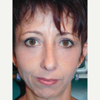 45 year old woman treated with RESET Laser Skin Resurfacing of Lower Eyelid Festoons/Malar Mounds after 1942957
