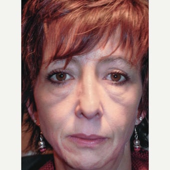 45 year old woman treated with RESET Laser Skin Resurfacing of Lower Eyelid Festoons/Malar Mounds before 1942957