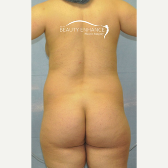 Tummy Tuck & BBL before 3072368