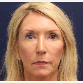 45-54 year old woman treated with Bellafill after 3143217