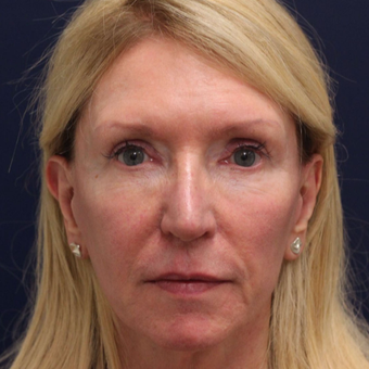 45-54 year old woman treated with Bellafill before 3143217