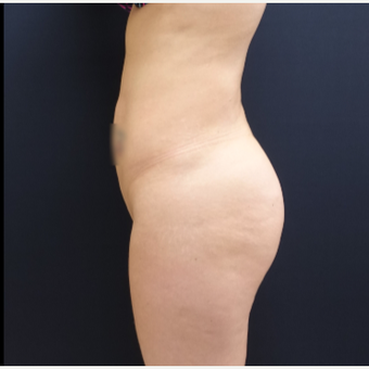 25-34 year old woman treated with Butt Augmentation using 712cc Round Silicone Butt Implants before 3259523