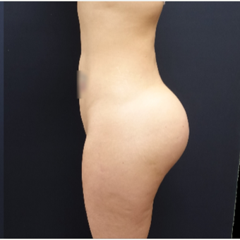 25-34 year old woman treated with Butt Augmentation using 712cc Round Silicone Butt Implants after 3259523