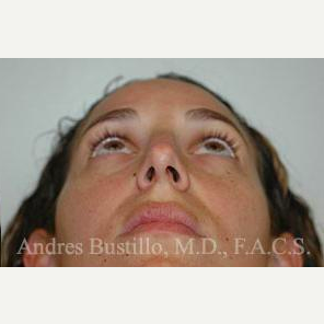 35 year old woman treated with Rhinoplasty after 3461054