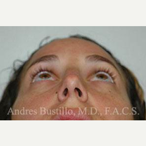35 year old woman treated with Rhinoplasty before 3461054