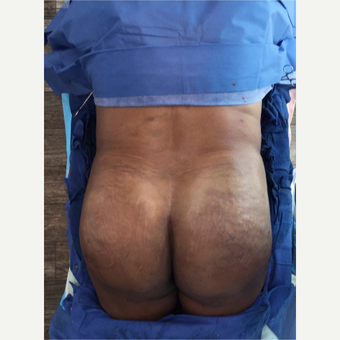 Woman treated with Brazilian Butt Lift after 3220306