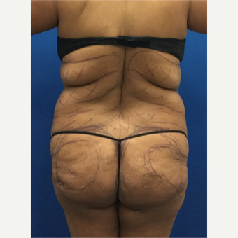 Woman treated with Brazilian Butt Lift before 3220306