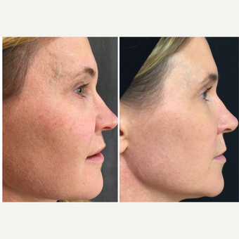 45-54 year old woman treated with Skin Rejuvenation before 3129691