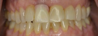 Infected Tooth Replaced & More before 3004919