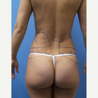 35-44 year old woman treated with Smart Lipo before 3098096