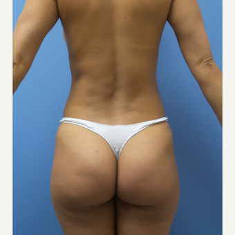 35-44 year old woman treated with Smart Lipo after 3098096