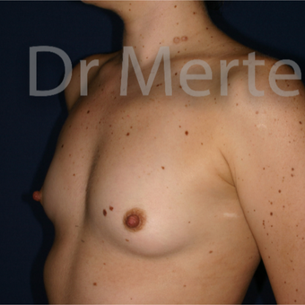 18-24 year old woman treated with Breast Augmentation before 3552662
