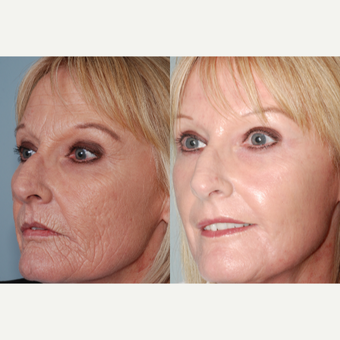 55-64 year old woman treated with Laser Resurfacing after 3415157