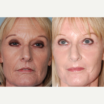 55-64 year old woman treated with Laser Resurfacing before 3415157