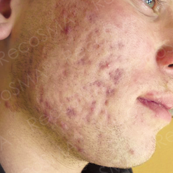 25 year old man with post-acne scars treated with RecoSMA before 2974604