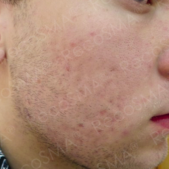 25 year old man with post-acne scars treated with RecoSMA after 2974604