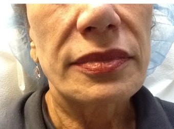 Restylane before and after before 1412674
