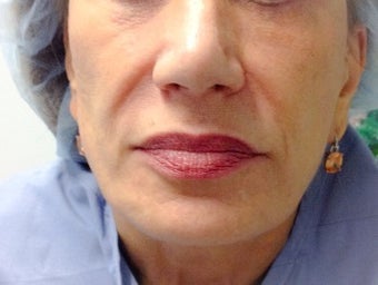 Restylane before and after after 1412674