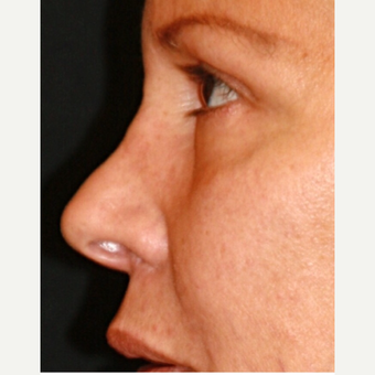 65-74 year old woman treated with fat transfer Nose Job before 3139571