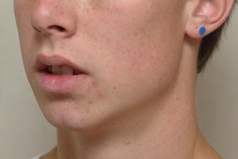Genioplasty (Chin) Surgery & Ramal Augmentation after 1070877