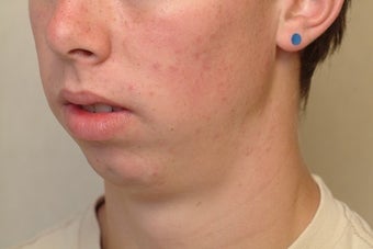 Genioplasty (Chin) Surgery & Ramal Augmentation before 1070877