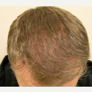 40 year old man treated with FUE Hair Transplant after 3763953