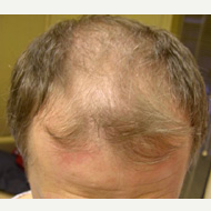 40 year old man treated with FUE Hair Transplant before 3763953