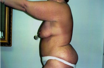 25-34 year old woman treated with Tummy Tuck 2663432