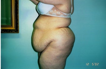25-34 year old woman treated with Tummy Tuck 2663432