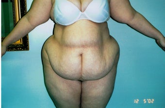 25-34 year old woman treated with Tummy Tuck before 2663432