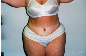 25-34 year old woman treated with Tummy Tuck after 2663432