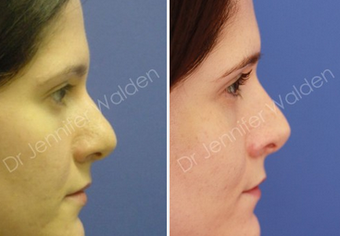 Septorhinoplasty before 1112646