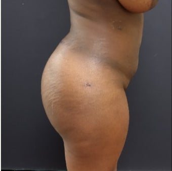 25-34 year old woman treated with Liposuction after 3363930