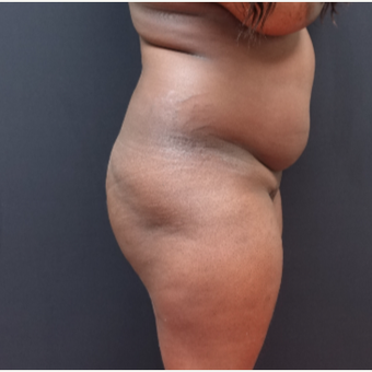 25-34 year old woman treated with Liposuction before 3363930