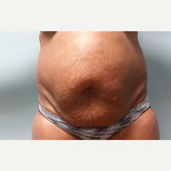35-44 year old woman treated with Laser Liposuction before 3764291