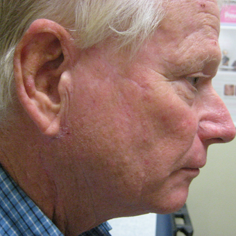 65-74 year old man treated with MOHs reconstruction after 3850431