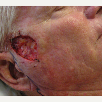 65-74 year old man treated with MOHs reconstruction before 3850431