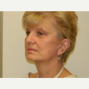 65-74 year old woman treated with Mini Lift, browlift and 4-Lid Blepharoplasty after 3264864