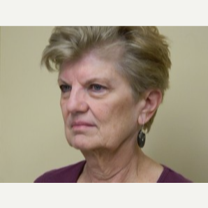 65-74 year old woman treated with Mini Lift, browlift and 4-Lid Blepharoplasty before 3264864