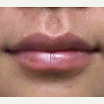 Restylane to enhance the lips after 2987950