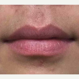 Restylane to enhance the lips before 2987950