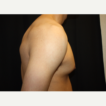 18-24 year old man treated with Male Breast Reduction before 3186303