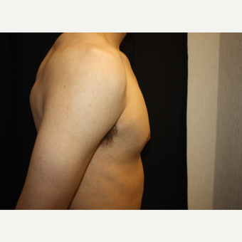 18-24 year old man treated with Male Breast Reduction after 3186303