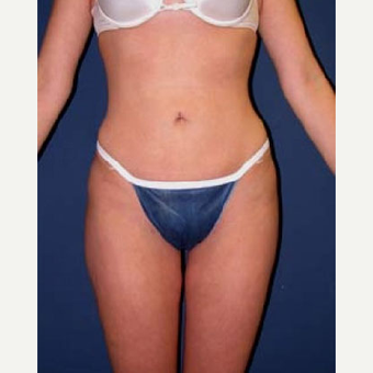 35-44 year old woman treated with SAFELipo after 3126337
