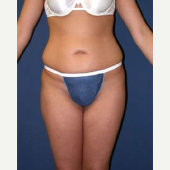 35-44 year old woman treated with SAFELipo before 3126337